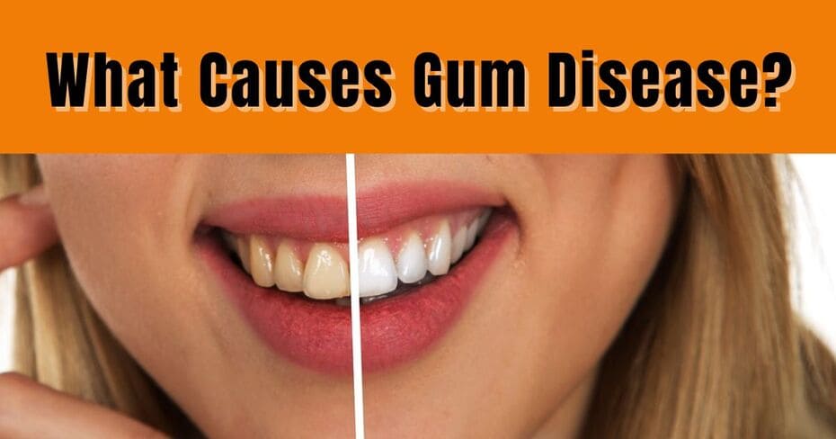 What Causes Gum Disease? Symptoms, Risk Factors, and Prevention